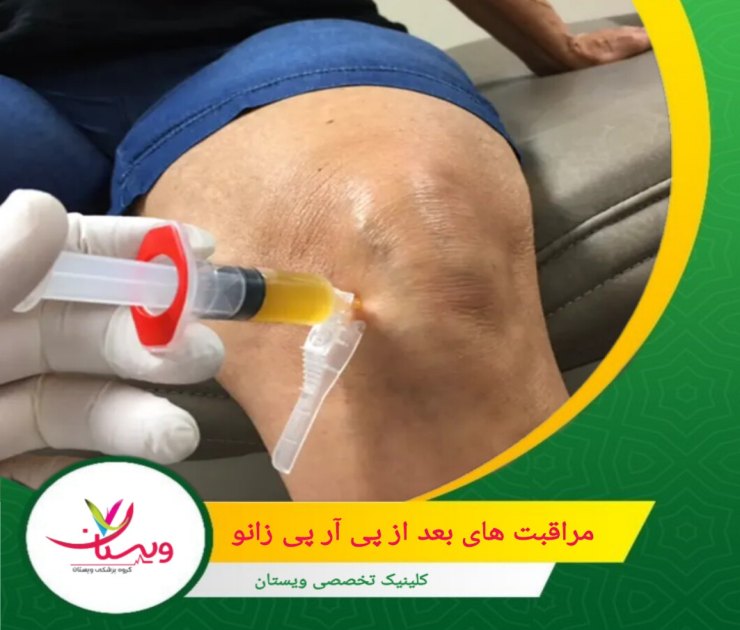 تا هشت ساعت پس از درمان از استحمام، دوش گرفتن یا شنا خودداری کنید. مراقبت های بعد از پی آر پی زانو