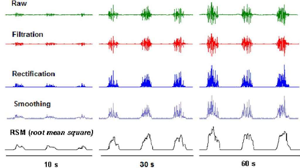 نتایج نوار عصب تفسیر نوار عصب دو اندام