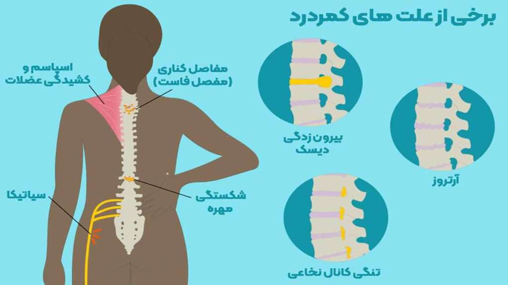 انواع مشکلات کمر انواع درد کمر