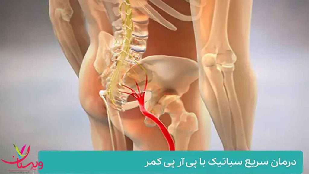 درمان دیسک کمر مزایا پی ار پی
