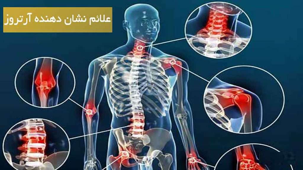 علائم آرتروز علائم آرتروز دست-چند عکس نشان دهنده آرتروز در یک پس زیمینه