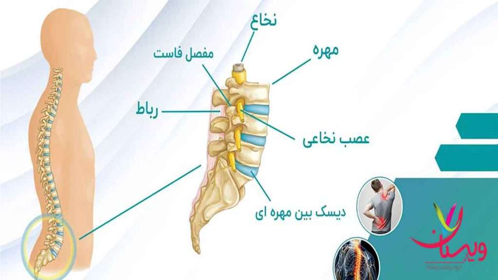 درمان دیسک کمر علائم دیسک کمر و سیاتیک