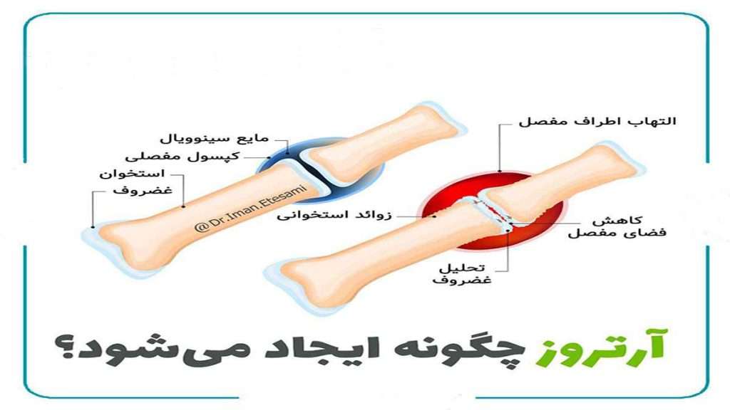 آیا آرتروز خطرناک است آرتروز چگونه بوجود میاد