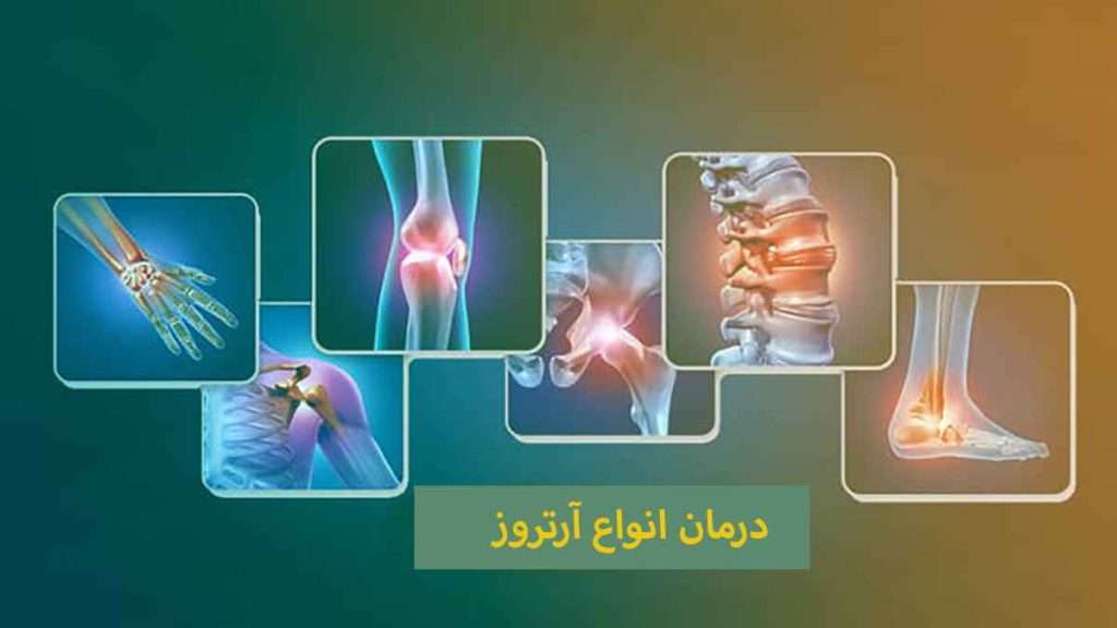 درمان آرتروز درمان آرتروز