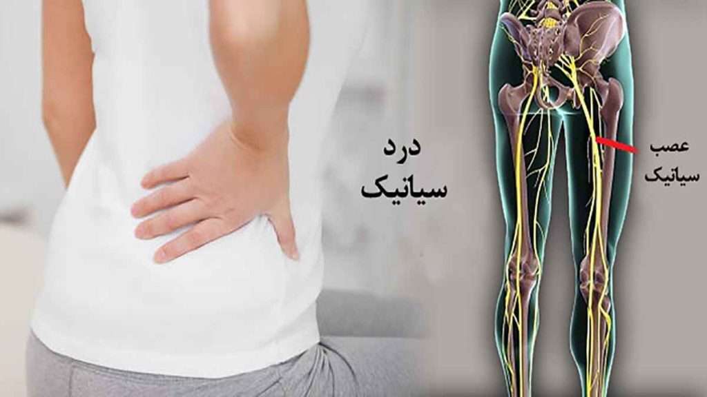 درد سیاتیک تفاوت درد دیسک کمر و سیاتیک