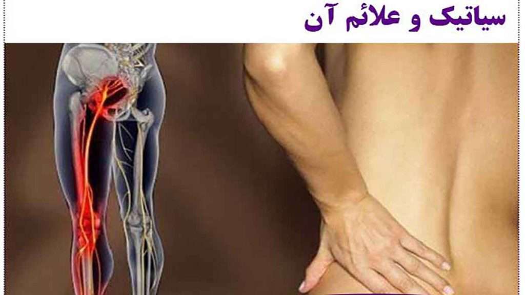 علائم سیاتیک علائم درد سیاتیک