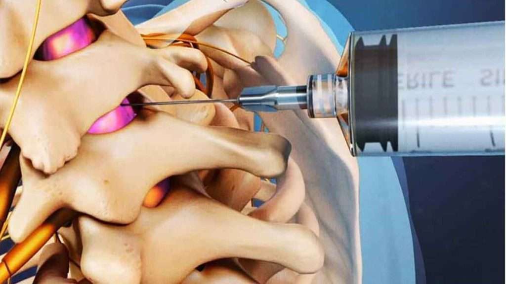 تزریق پی ار پی کمر نحوه انجام پی ار پی