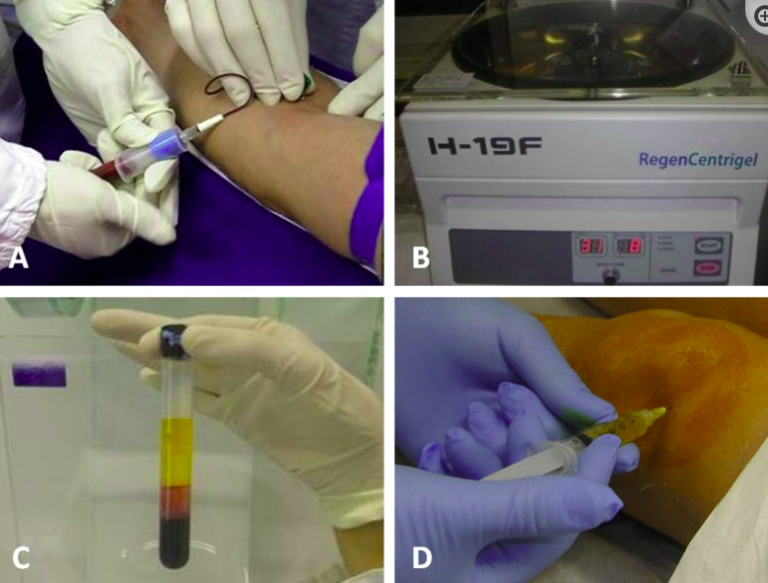 مراحل انجام تزریق پی ار پی زانو