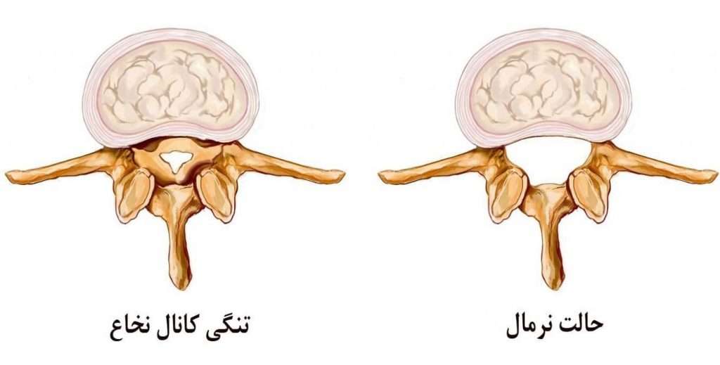 تفاوت کانال نخاع نرمال و بیمار تفاوت کانال نخاع نرمال و بیمار