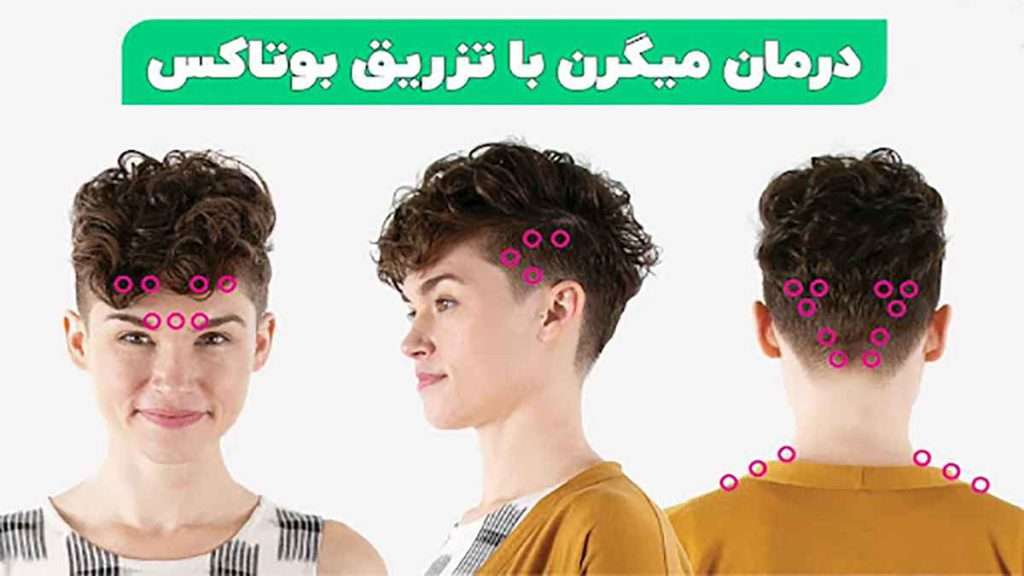 تزریق بوتاکس روش های درمان میگرن