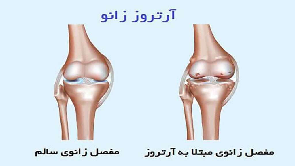 درمان قطعی آرتروز درمان قطعی آرتروز