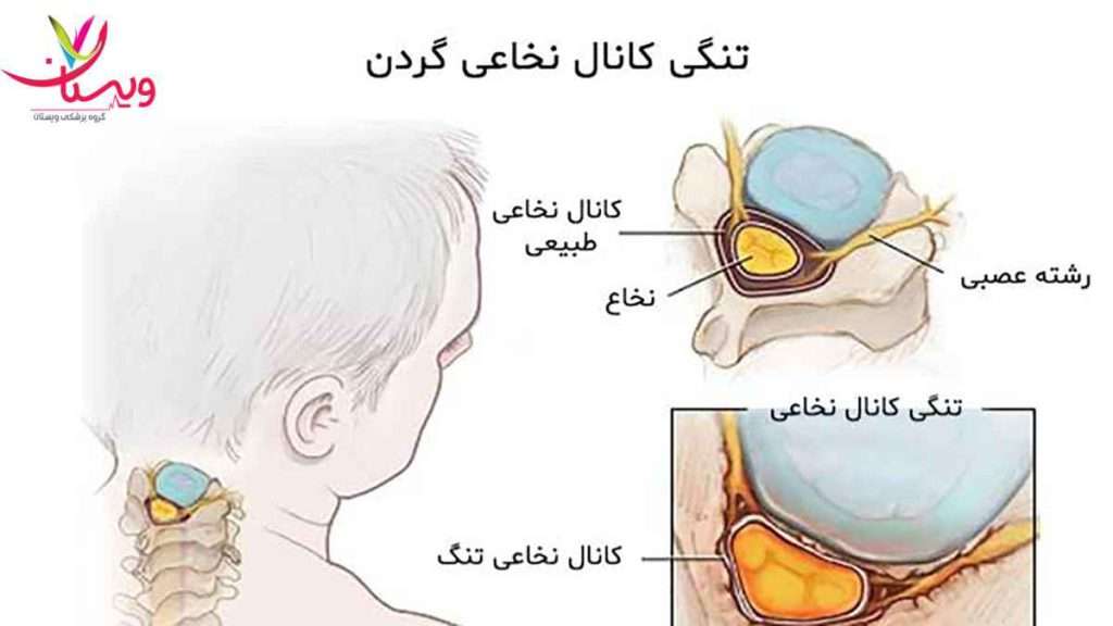 علائم تنگی کانال نخاعی