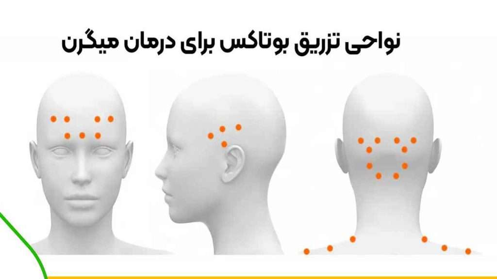 نقاط تزریق بوتاکس نواحی تزریق بوتاکس میگرن