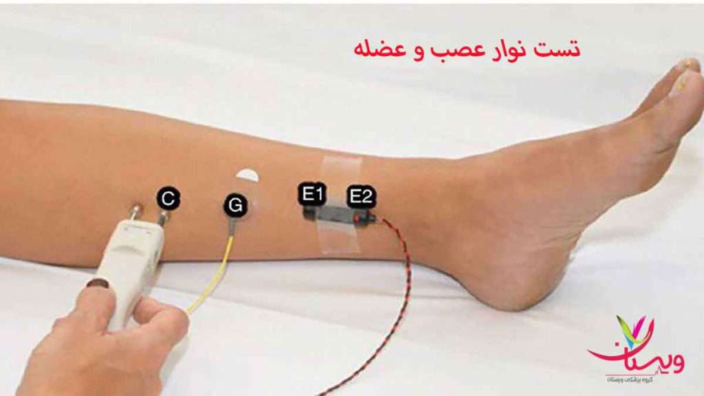 نوار عصب پا انواع نوار عصب
