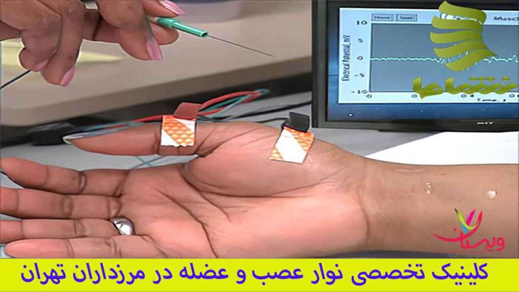 نوار عصب برای دست کاربرد نوار عصب