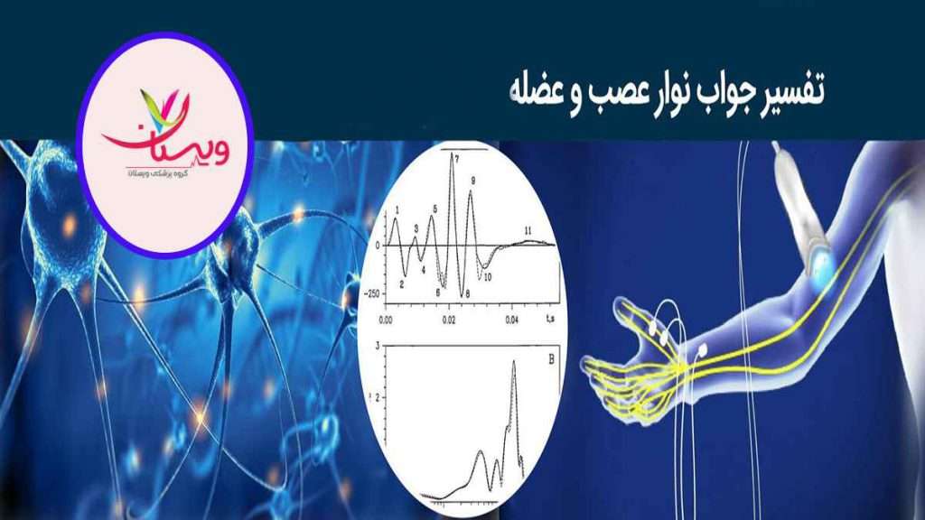 تفسیر نوار عصب تفسیر نوار عصب