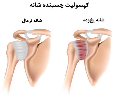 شانه یخ زده_عامل شانه یخ زده