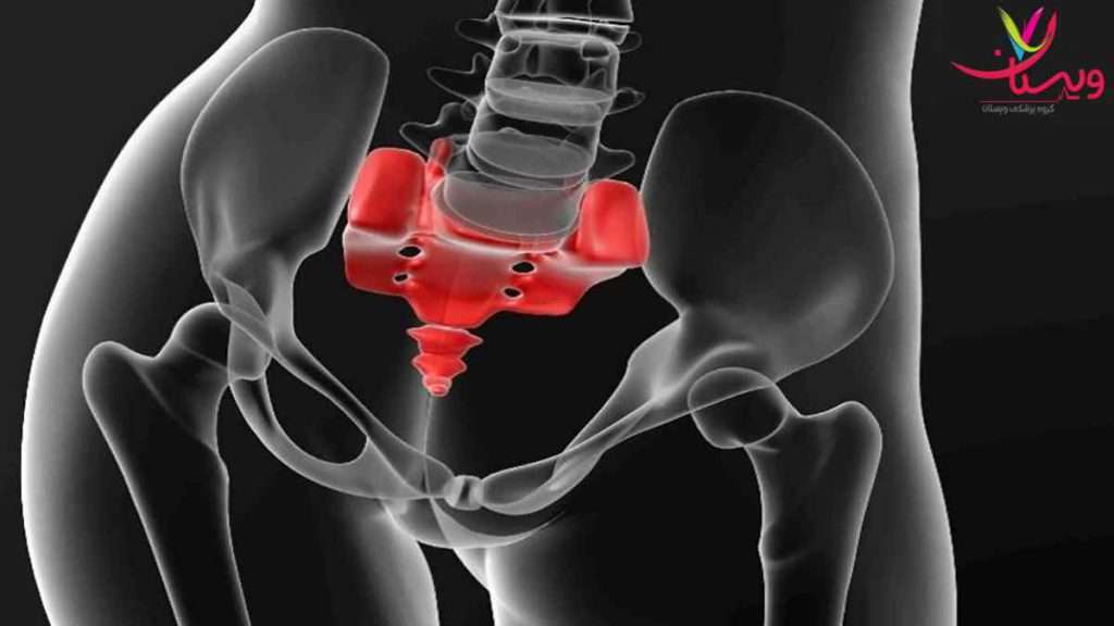 دنبالچه درد استراحت بعد از جا انداختن دنبالچه