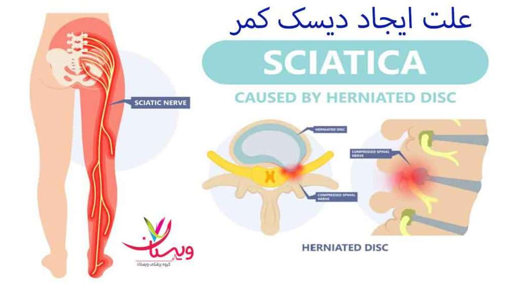علت دیسک کمر علت دیسک کمر