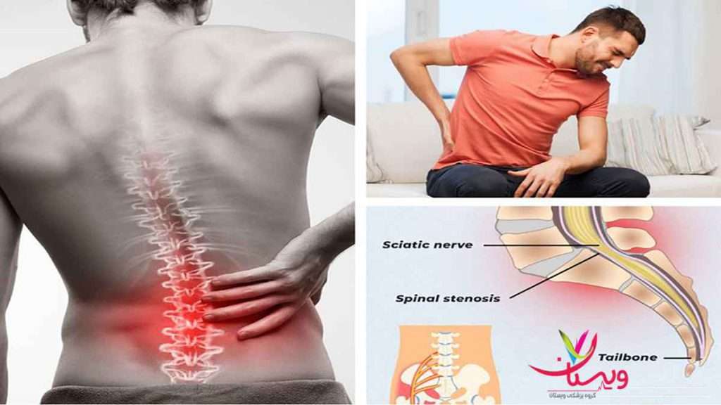 فیزیوتراپی دیسک کمر درمان دیسک کمر