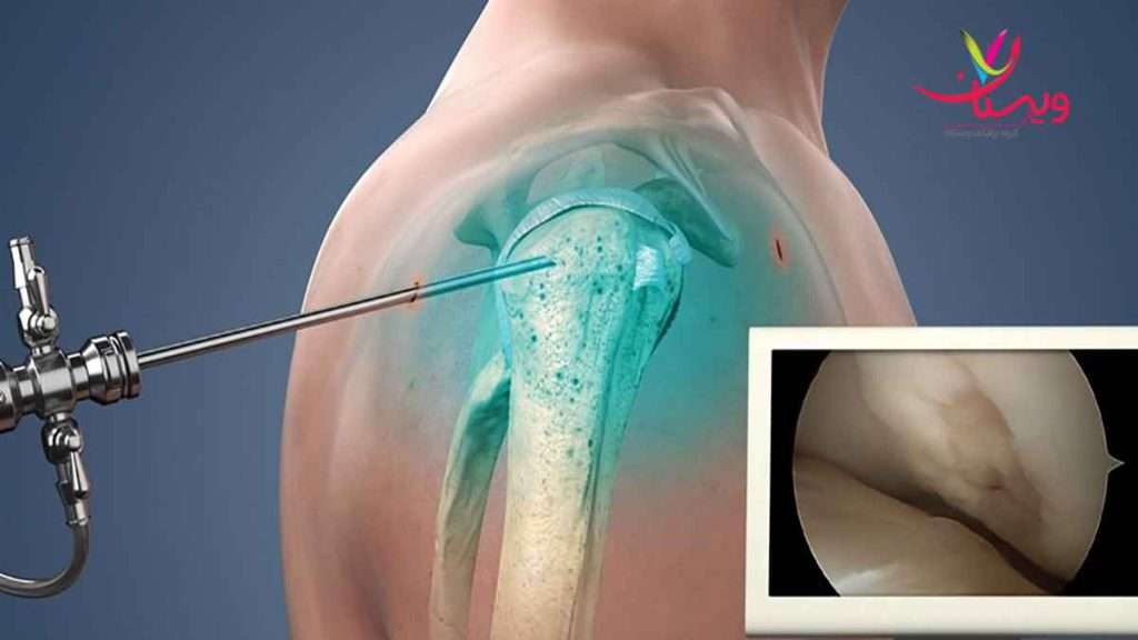 تزریق پی ار پی به شانه مقایسه پی ار پی با سایر روش ها