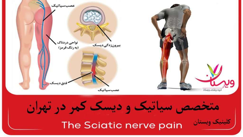 درد در ناحیه کمر و سیاتیک که تا مچ پا کشیده می شود