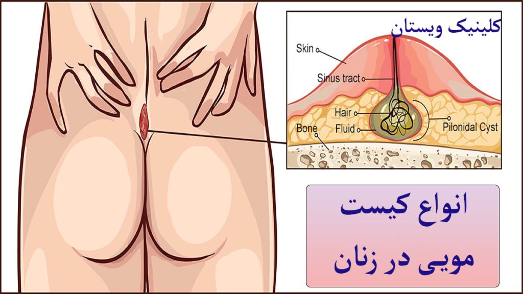 انواع کیست مویی انواع کیست مویی نمایش داده می شود