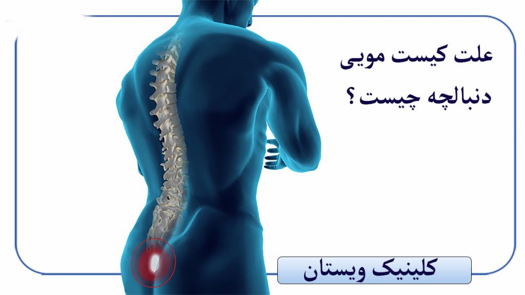 کیست مویی دنبالچه کیست مویی دنبالچه ر شخصی نمایش داده می وشد