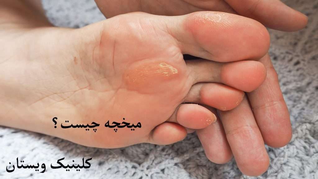 میخچه پای فرد دارای میخچه