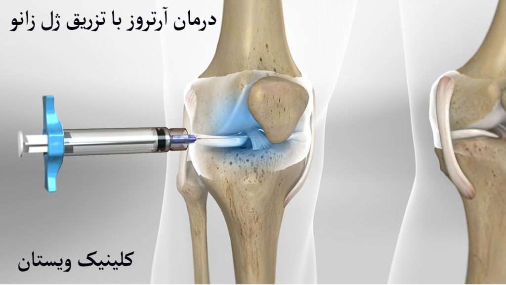 درمان آرتروز با تزریق داخل مفصلی تزریق به مفص دارای آرتروز