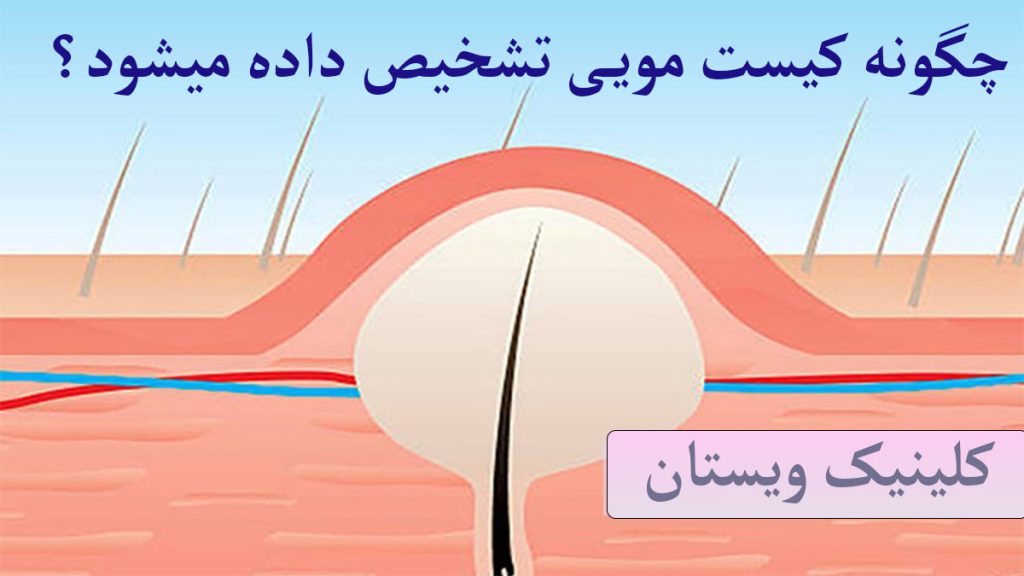 تشخیص کیست مویی توده کیست مویی نمایش داده می شود