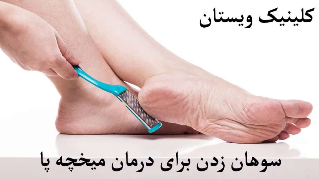 درمان میخچه پا شخصی برای درمان میخچه پاشنه پا را سوهان می کشد