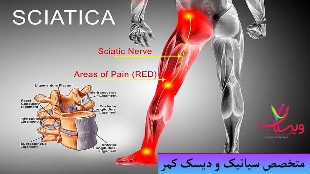 درد در یک طرف پا که از علائم سیاتیک محسوب می شود از نظر متخصص سیاتیک و دیسک کمر