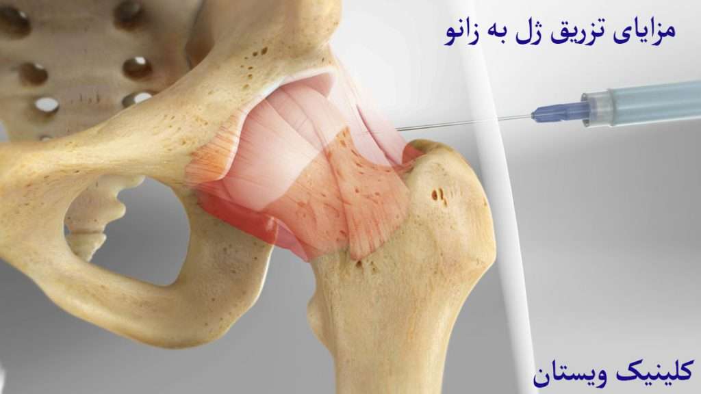 تزریق داخل مفصلی تزریق ژل به مفصل