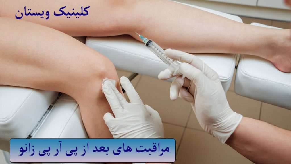 مراقبت بعد از پی ارپی عمل تزریق پی ار پی به زانوی بیمار انجام شده است