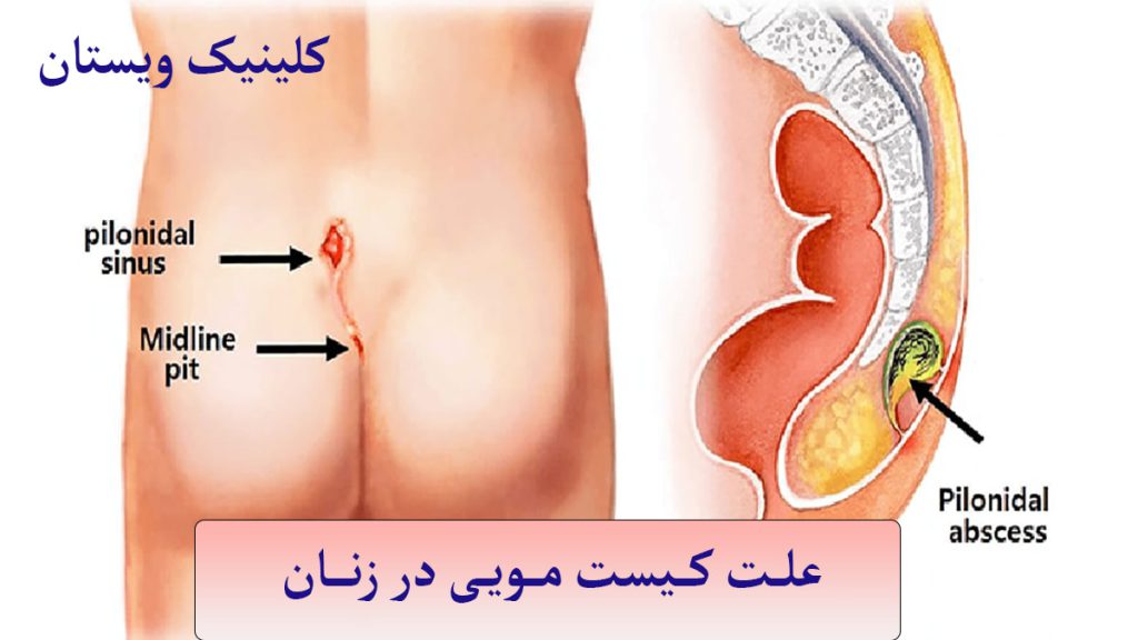 علت کیست مویی در زنان کیست مویی در ناحیه دنبالچه نمایش داده می شود