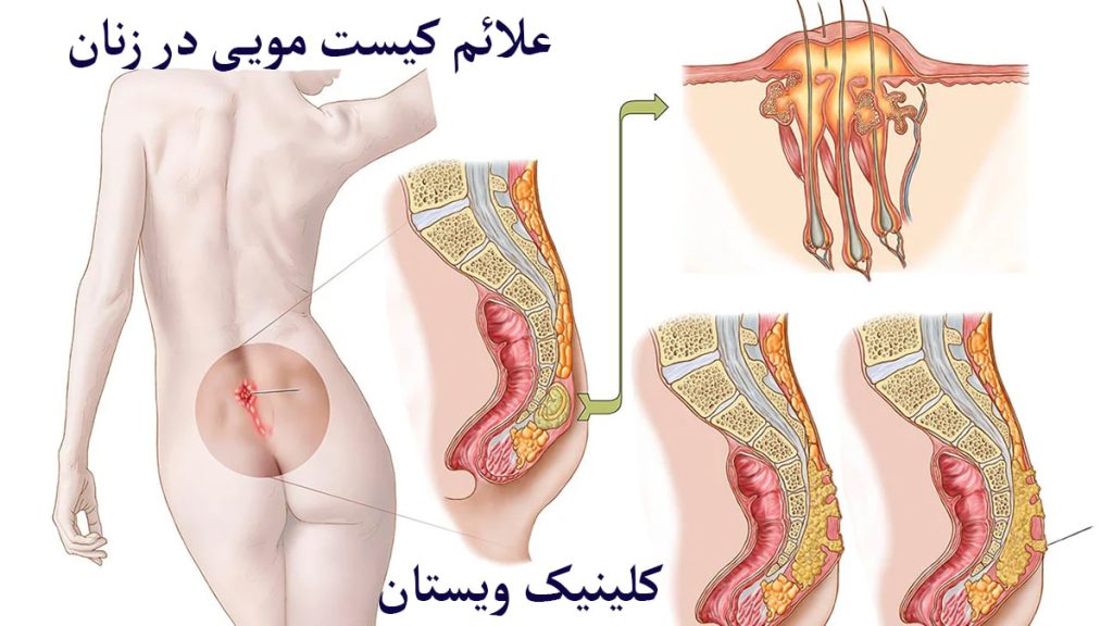 علائم کیست مویی خانمی که دارای کیست مویی است نمایش داده می وشد