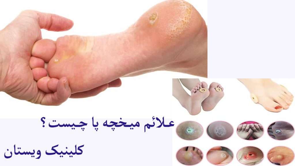 انواع میخچه انواع میخچه کف پا را نمایش می دهد