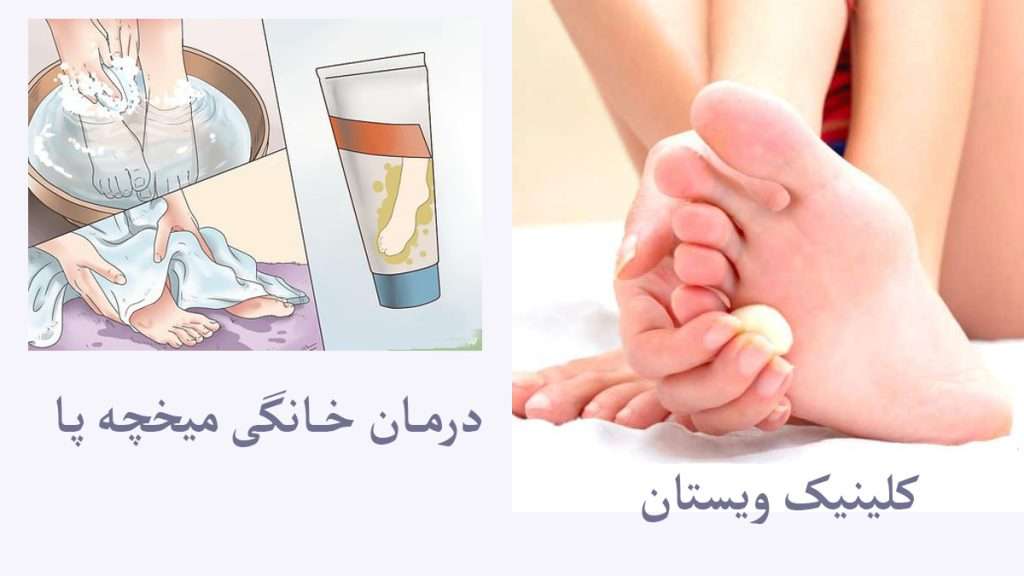 روش های درمان خانگی میخچه استفاده از روش های خانگی برای میخچه