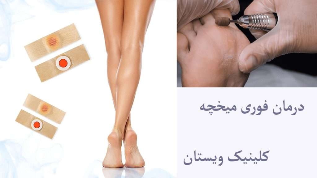 روشهای درمان سریع میخچه درمان میخچه با چسب و سوهان