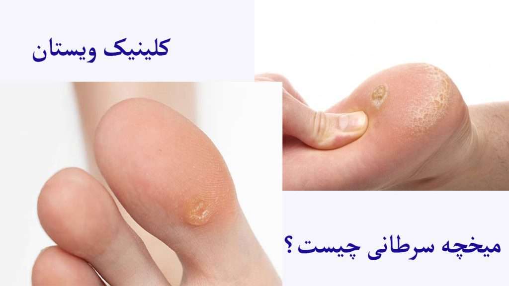 میخچه سرطانی میخچه پاشنه و شصت پا