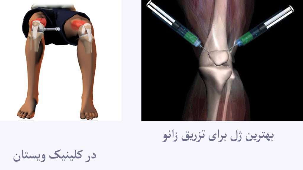 بهترین ژل زانو شخص نشسته و داخل مفصل زانوی او ژل تزریق می شود