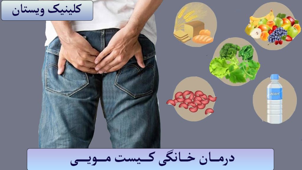 درمان خانگی کیست مویی رروش های درمان خانگی برای کیست مویی نمایش داده می شود