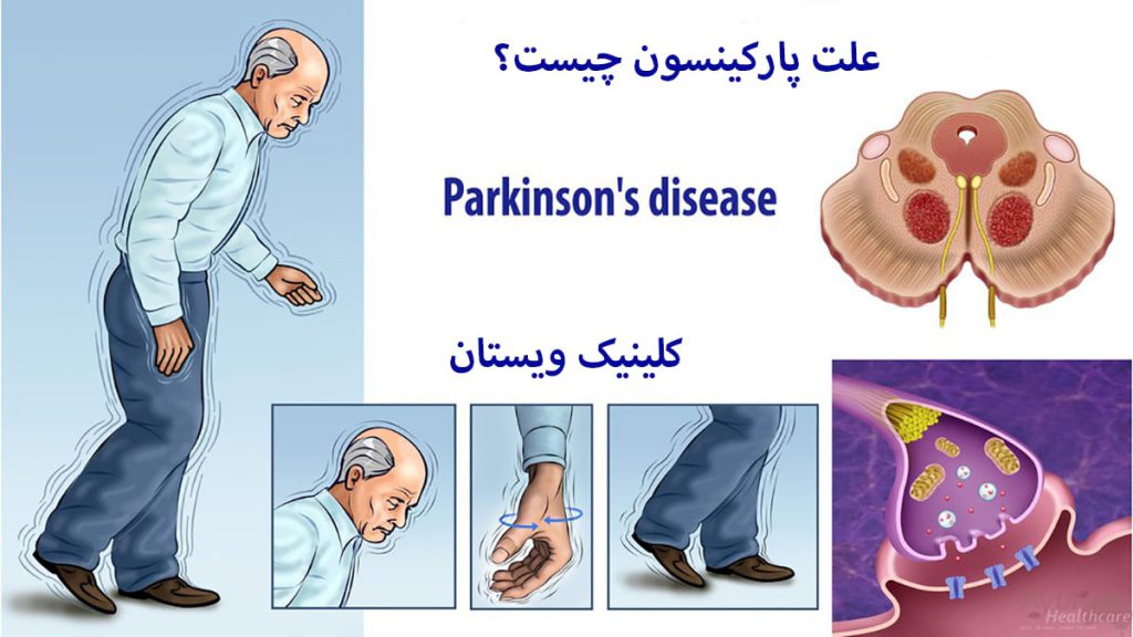 علت پارکینسون شخصی دارای بیماری پارکینسون و نوشه ای در خصوص علت پارکینسون نمایش داده می شود