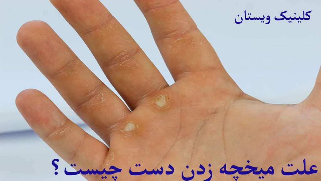 علت میخچه دست میخچه دست