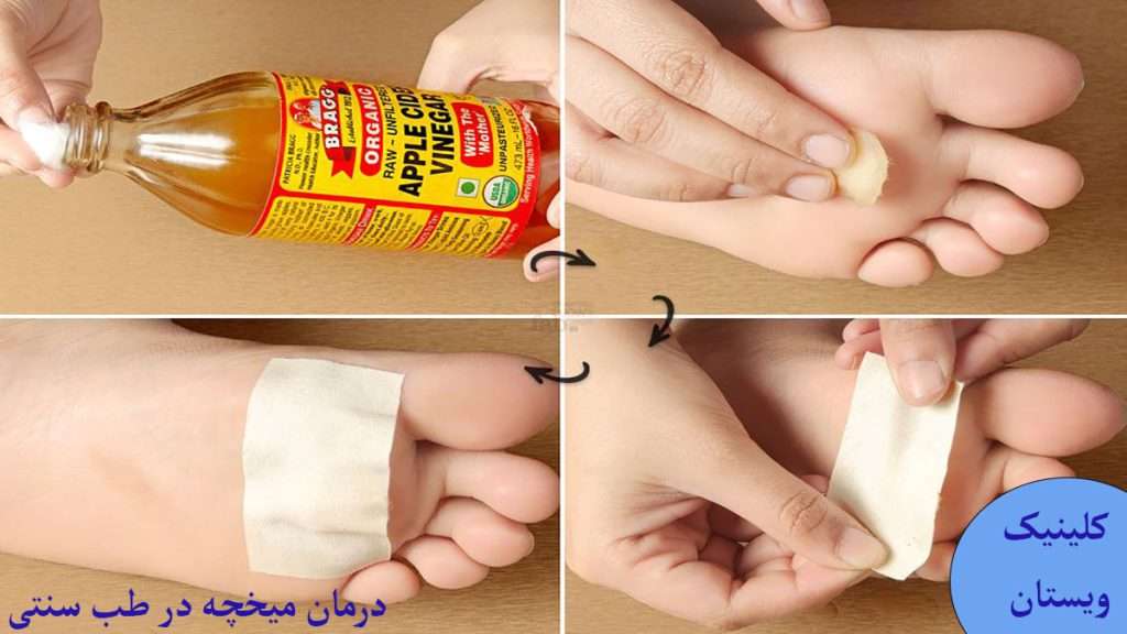 روش های درمان میخچه با طب سنتی درمان میخچه با طب سنتی