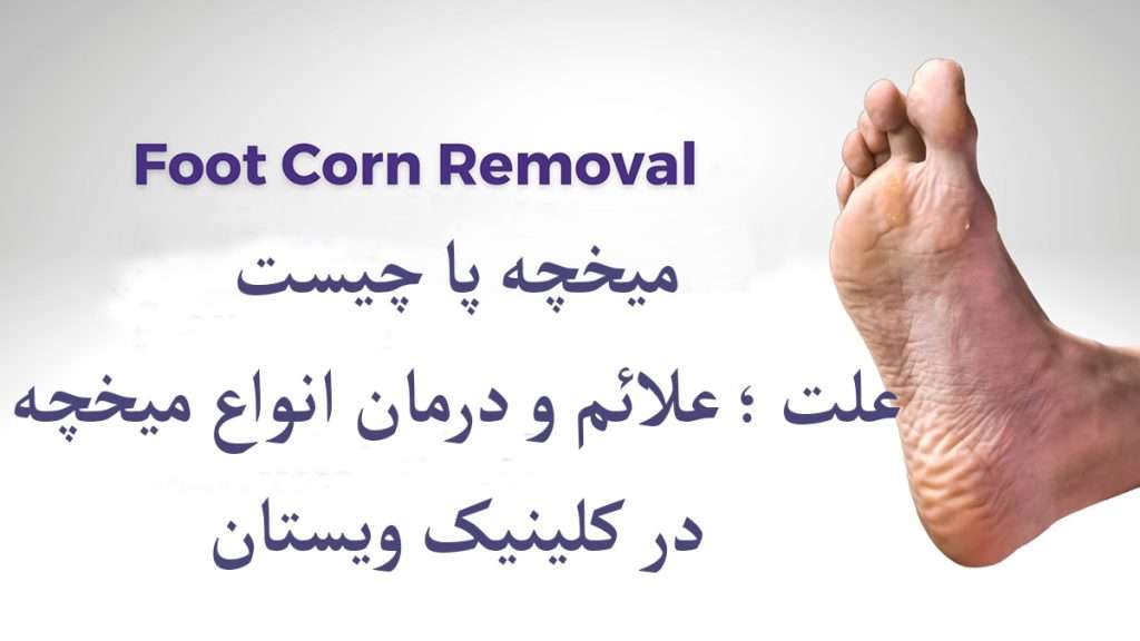 کف پای فرد دارای میخچه