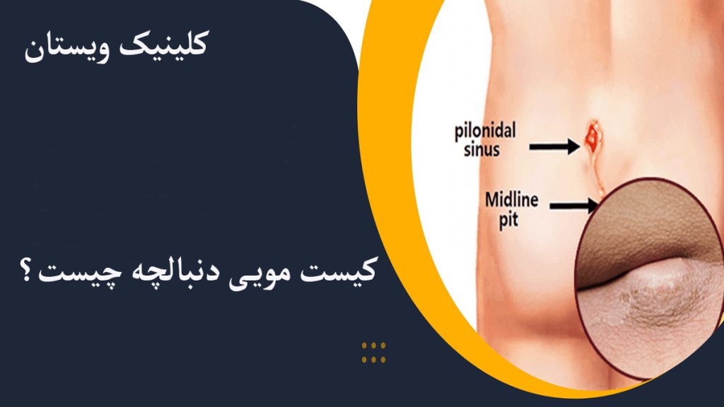 کیست مویی دنبالچه نمایش داده می شود