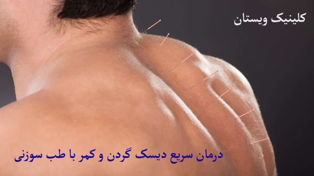 طب سوزنی طب سوزنی گردن نشان داده می شود