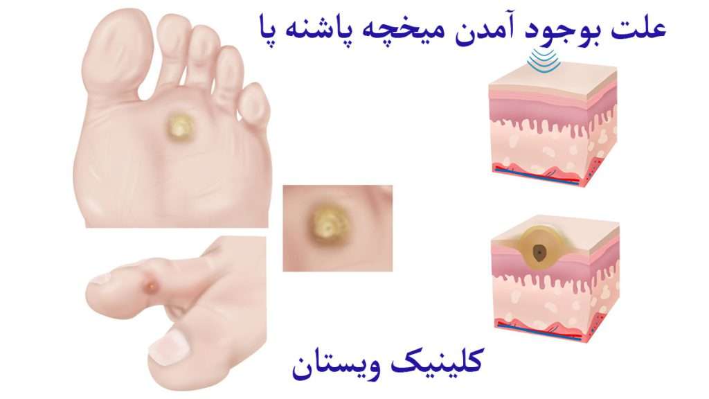 علت میخچه پاشنه پا لایه های پوست دارای میخچه